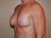 Breast Reconstruction Immediate Implant After Patient Thumbnail 3