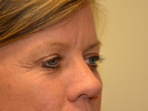 Brow Lift After Patient 3