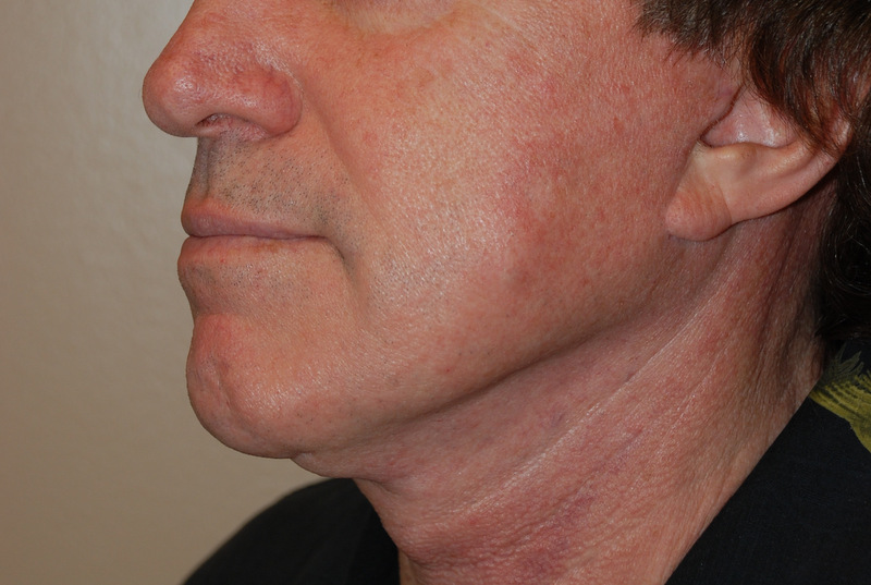Before and after pictures of a male facelift 2