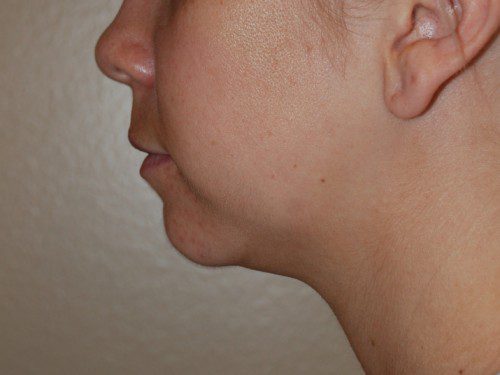 Neck Liposuction Before Patient 4