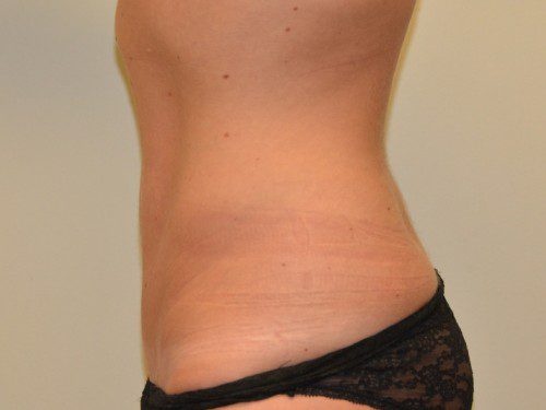 Mini Tummy Tuck After Patient 4