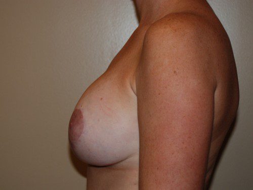 Breast Augmentation w/Lift After Patient 5