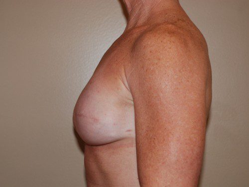 Breast Reconstruction Immediate Implant After Patient 5