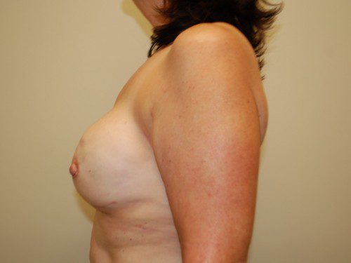 Breast Reconstruction Tissue Expanders After Patient 5
