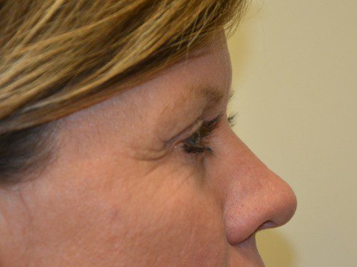 Brow Lift After Patient 5