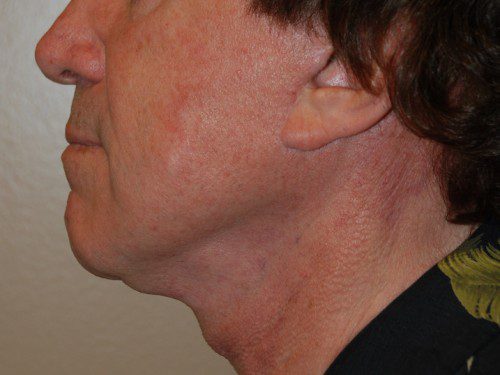 Facelift After Patient 5