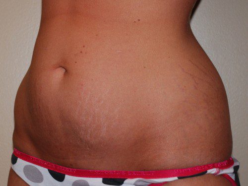 Liposuction Before Patient 2