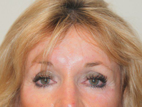 Brow Lift Before Patient 1