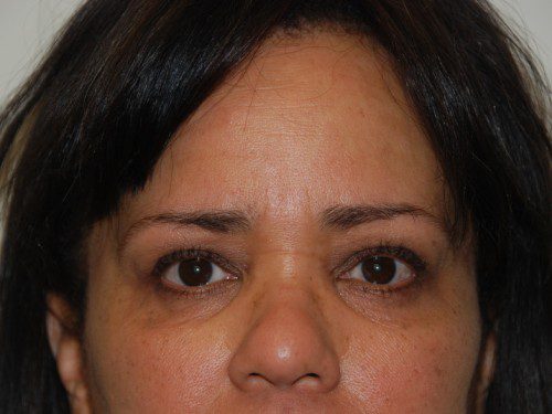 Eyelid Surgery Before Patient 1