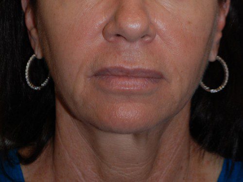 Facelift Before Patient 1