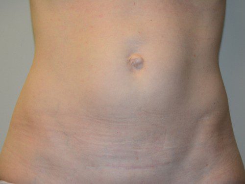 Mini Tummy Tuck Before Patient 1