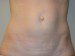 Mini Tummy Tuck Before Patient Thumbnail 1