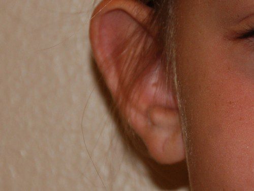 Prominent Ear Surgery Before Patient 1