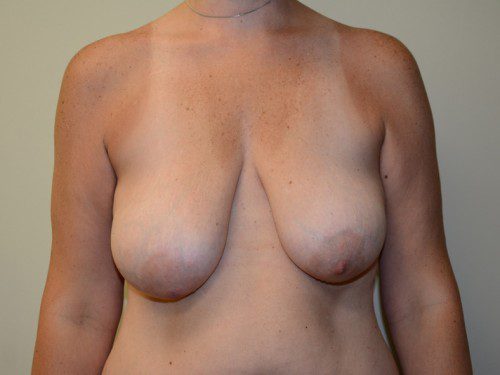 Breast Lift Before Patient 1