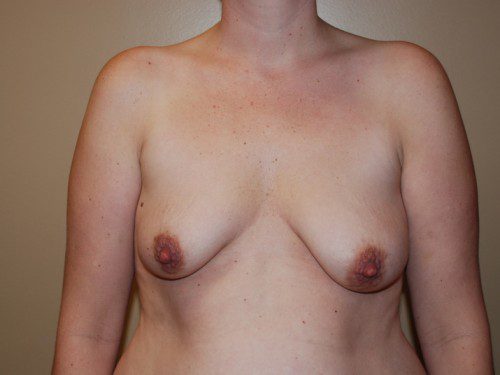 Breast Augmentation w/Lift Before Patient 1