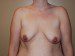 Breast Augmentation w/Lift Before Patient Thumbnail 1