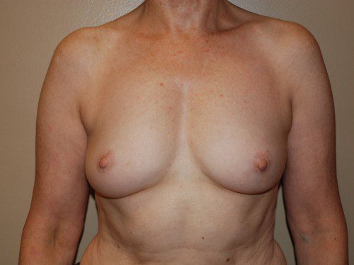 Breast Reconstruction Immediate Implant Before Patient 1