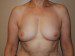 Breast Reconstruction Immediate Implant Before Patient Thumbnail 1