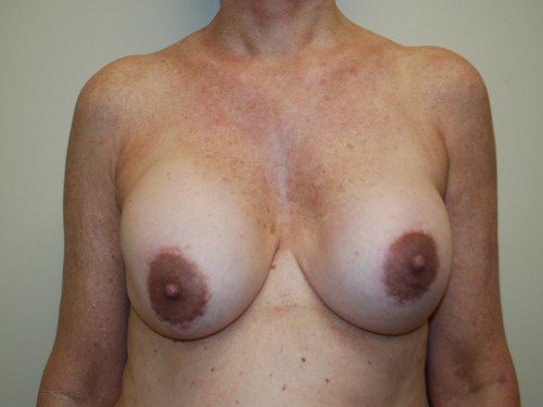 Breast Revision Before Patient 1