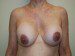 Breast Revision Before Patient Thumbnail 1
