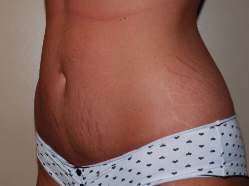 Liposuction After Patient 2