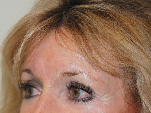 Brow Lift Before Patient 2