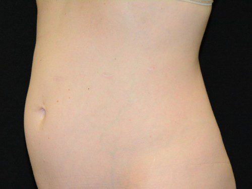 Coolsculpting Before Patient 2