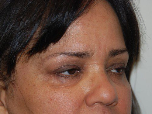 Eyelid Surgery Before Patient 2
