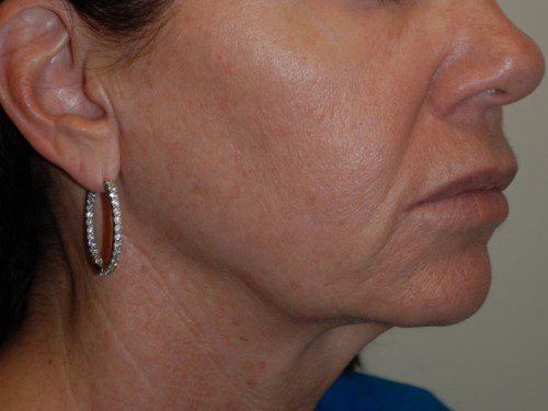 Facelift Before Patient 2