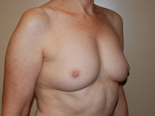 Breast Reconstruction Immediate Implant Before Patient 2