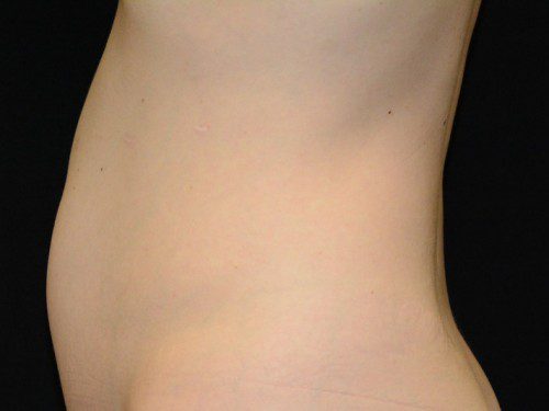 Coolsculpting Before Patient 4