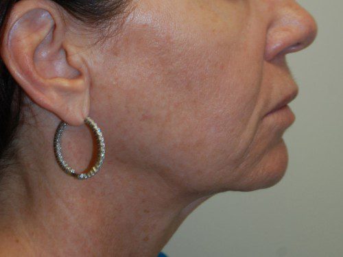 Facelift Before Patient 4