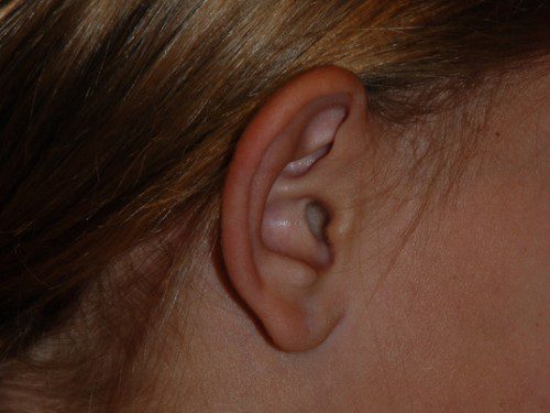 Prominent Ear Surgery Before Patient 3