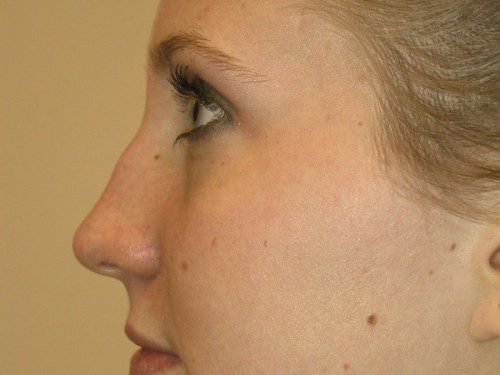 Rhinoplasty Before Patient 3