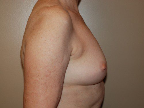 Breast Reconstruction Immediate Implant Before Patient 4