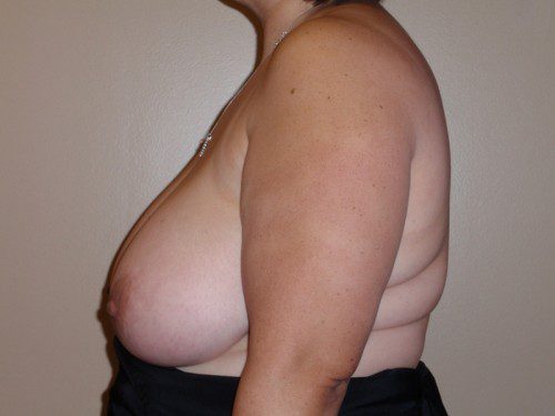 Breast Reduction Before Patient 4