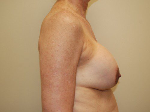 Breast Revision Before Patient 4