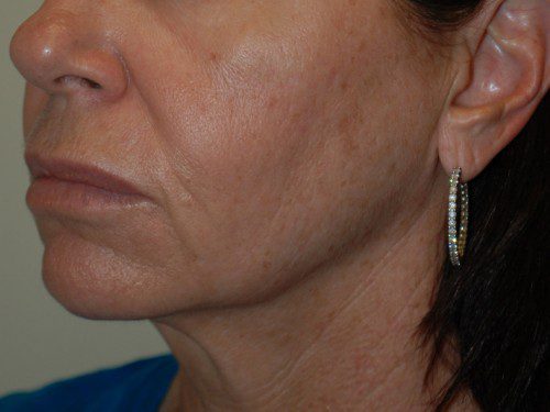 Facelift Before Patient 3