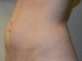 Mini Tummy Tuck Before Patient Thumbnail 3