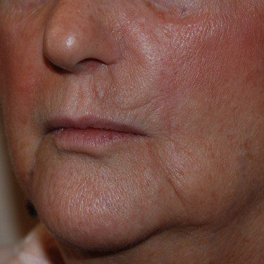 Skin Cancer Reconstruction After Patient 2