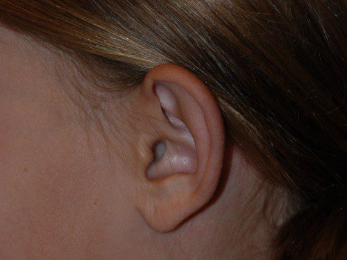 Prominent Ear Surgery Before Patient 4