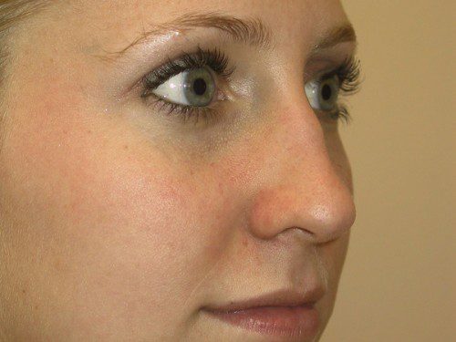 Rhinoplasty Before Patient 4