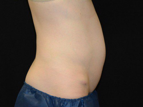 Coolsculpting Before Patient 5