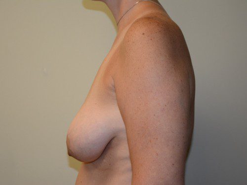 Breast Lift Before Patient 5