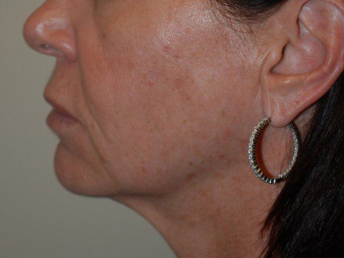 Facelift Before Patient 5