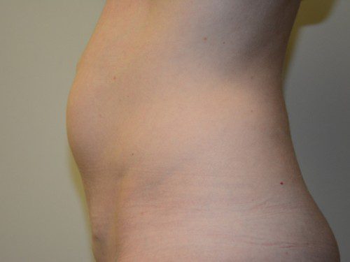 Mini Tummy Tuck Before Patient 5