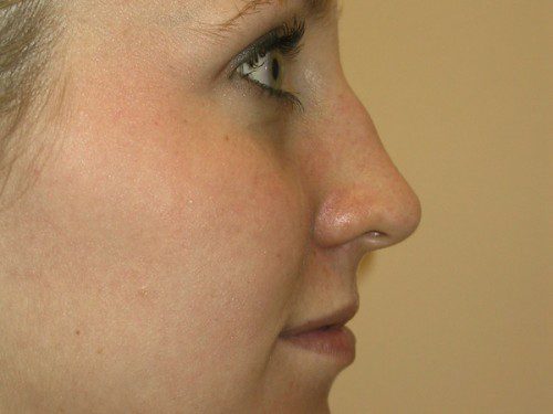 Rhinoplasty Before Patient 5