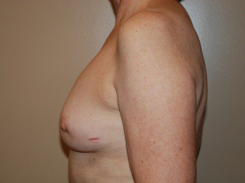 Breast Reconstruction Immediate Implant Before Patient 5