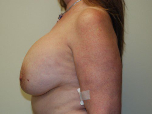 Breast Reconstruction Tissue Expanders Before Patient 5