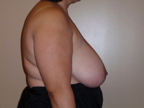 Breast Reduction Before Patient 5